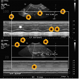 Thumb absence hypoplastic halluces