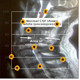 Blaichman syndrome